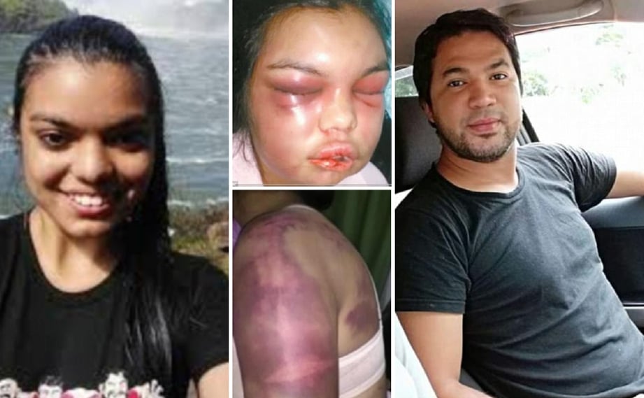 Ditumbuk suami untuk setiap 'Like' dari gambarnya di FB, wanita ini terpaksa jalani pembedahan pembetukan semula wajah