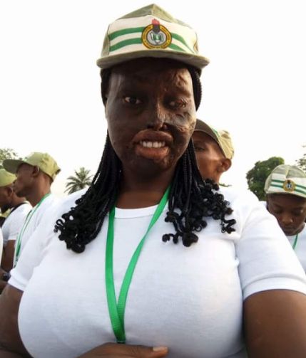 Lady Who Survived Acid Attack by Uncle’s Wife Begins NYSC