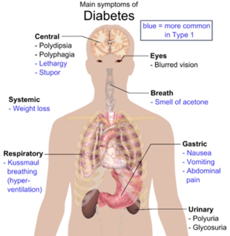 Type 1 Diabetes – Symptoms and Treatment