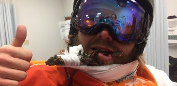 Fail natty hagood impales face on branch skiing