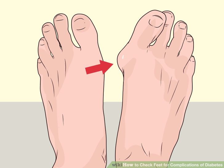 Check Feet for Complications of Diabetes Step 6.jpg