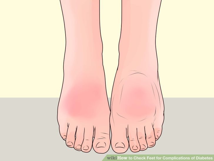 Check Feet for Complications of Diabetes Step 7.jpg