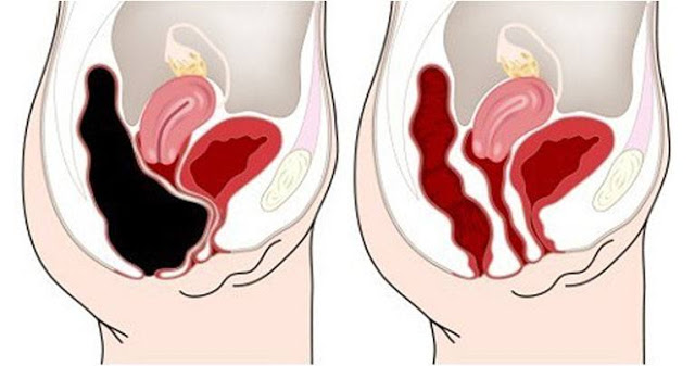 How to Remove 20 Pounds of Toxic Waste from Your Colon – Recipe