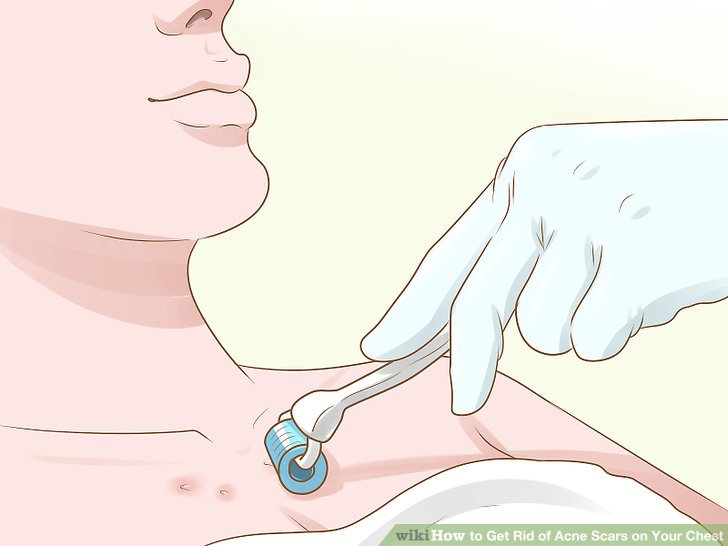 Get Rid of Acne Scars on Your Chest Step 2.jpg