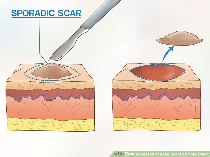 Get Rid of Acne Scars on Your Chest Step 8.jpg