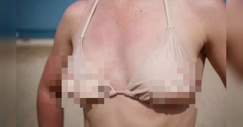 swimsuit that looks like naked breasts - cover photo for a list of awful bathing suits
