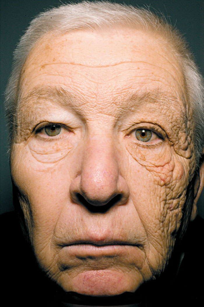 Sun Damage After 28 Years Of Driving A Delivery Truck