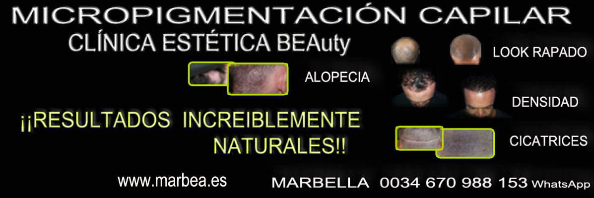 clinica estética, micropigmentación capilar en Marbella or en Marbella y maquillaje permanente en marbella