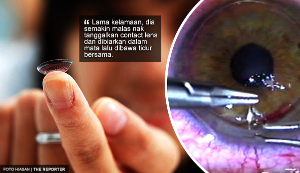 Terlupa tanggalkan contact lens 5 bulan, wanita buta sebelah mata
