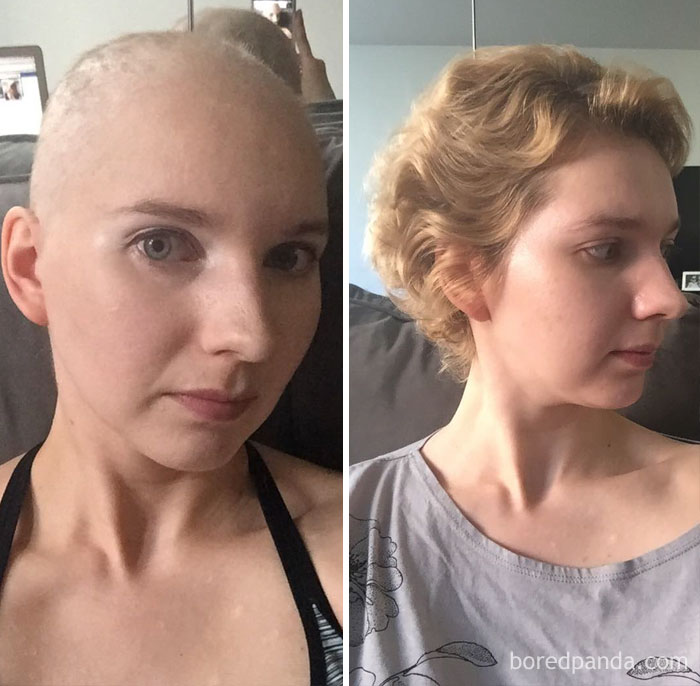 One Year Ago I Had No Choice But To Shave Off My Hair Because It Was Falling Out Because Of Chemotherapy. But Here I Am 8 Months Post Chemo With Crazy Chemo Curls