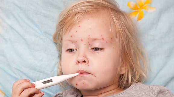 Κρούσμα ιλαράς στον Βόλο σε παιδί 3 ετών – Αναφέρθηκε στο ΚΕΕΛΠΝΟ
