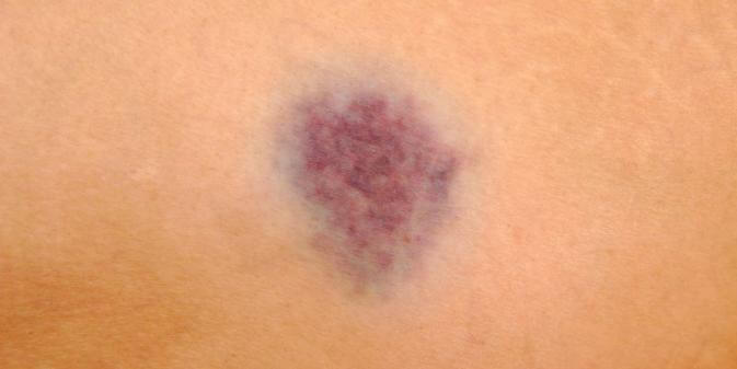 a photo of a dark bruise on skin
