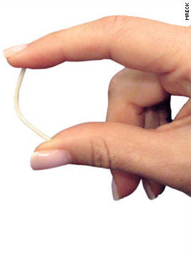 Implants are flexible, matchstick-size devices that are surgically inserted into a woman's arm. They slowly release the hormone progestin into the body, which prevents a woman's ovaries from releasing eggs. The protection lasts up to several years. Norplant, the first marketed contraceptive implant, made its debut in the United States in 1993. It involved six rods implanted into the arm at one time. It was discontinued in the U.S. in 2002, but is still used successfully in other countries. Implanon, which was approved by the FDA in 2006, uses only one rod and lasts up to three years.