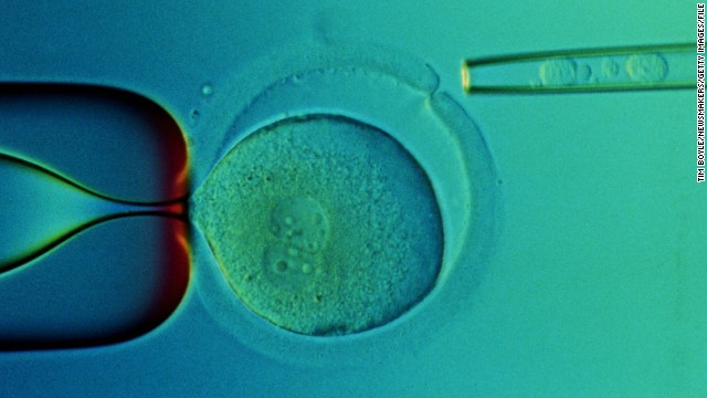 A closeup of a microscope slide taken in 2000 at the Reproductive Genetics Institute's Chicago laboratory shows transplanted stem cells taken from the umbilical cord blood of a baby named Adam Nash. Adam's sister Molly has a genetic disease called Franconi Anemia. Their parents wanted to have a child who could be a stem cell donor for Molly. Using in vitro fertilization, doctors created embryos and then tested them for the genetic disease. They chose one that did not have the disorder, which grew into baby Adam. Molly received a stem cell transplant from stem cells from Adam's umbilical cord. Both children are alive today.