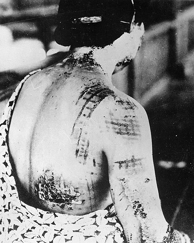 A patient's skin is burned in a pattern corresponding to the dark portions of a kimono worn at the time of the explosion