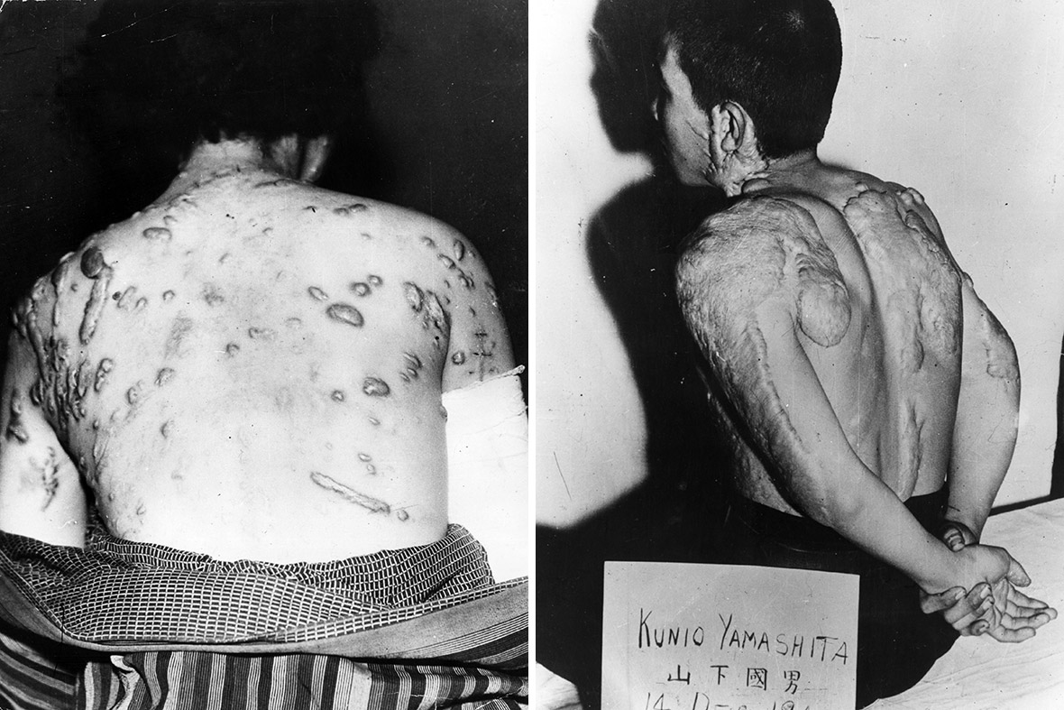 Patients at the Tokyo Imperial University Hospital display injuries suffered as a result of the atomic bomb that was dropped on Hiroshima