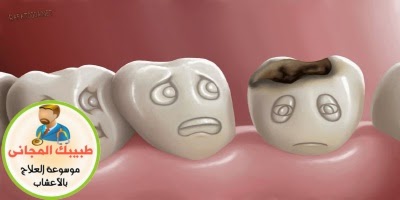 أسباب تسوس الاسنان وعلاجه
